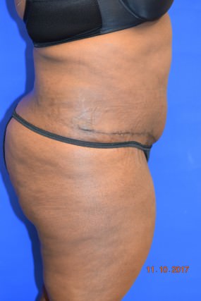 Tummy Tuck