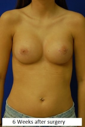 Breast Procedures