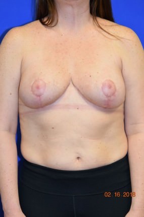 Breast Procedures