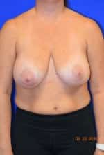 Breast Procedures