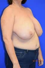 Breast Procedures