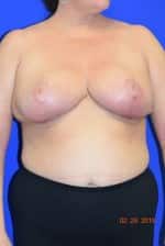 Breast Procedures