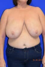 Breast Procedures