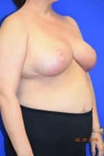 Breast Procedures