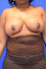 Breast Procedures