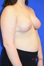 Breast Procedures