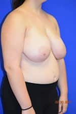 Breast Procedures