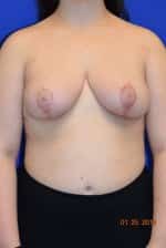 Breast Procedures