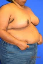 Breast Procedures