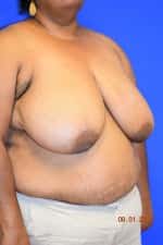 Breast Procedures