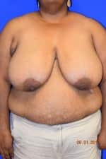 Breast Procedures