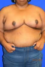 Breast Procedures
