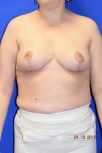 Breast Procedures
