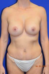 Breast Procedures