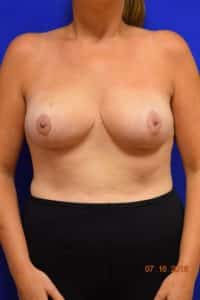 Breast Procedures