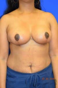 Breast Procedures