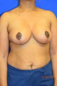 Breast Procedures
