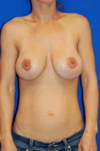 Breast Procedures