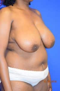 Breast Procedures