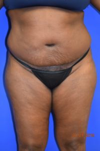 Body Procedures