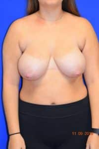 Breast Procedures
