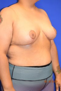 Breast Procedures
