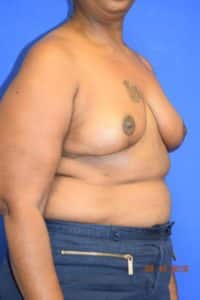 Breast Procedures