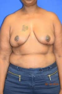 Breast Procedures