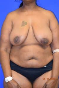 Breast Procedures