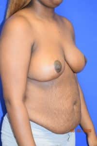 Breast Procedures