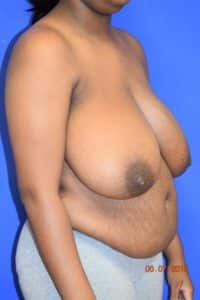 Breast Procedures