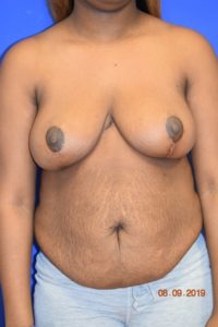 Breast Procedures