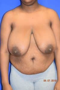 Breast Procedures
