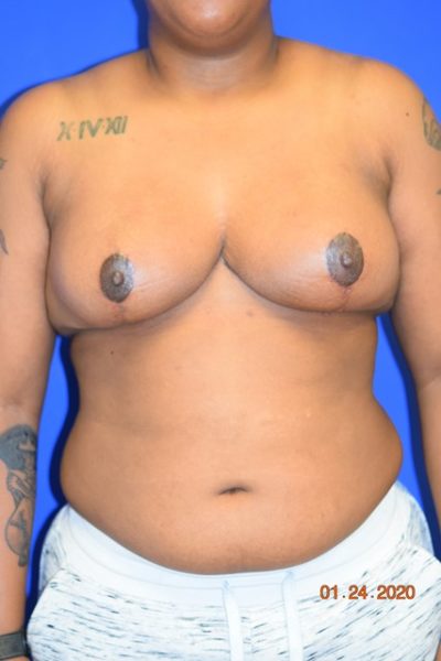 Breast Procedures