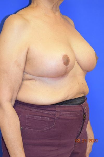 Breast Reduction