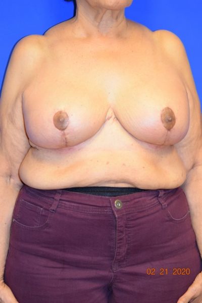 Breast Reduction