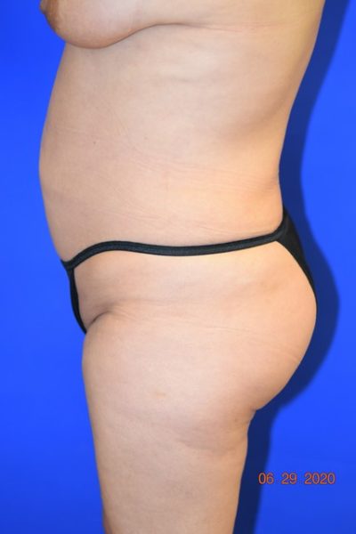 Body Procedures