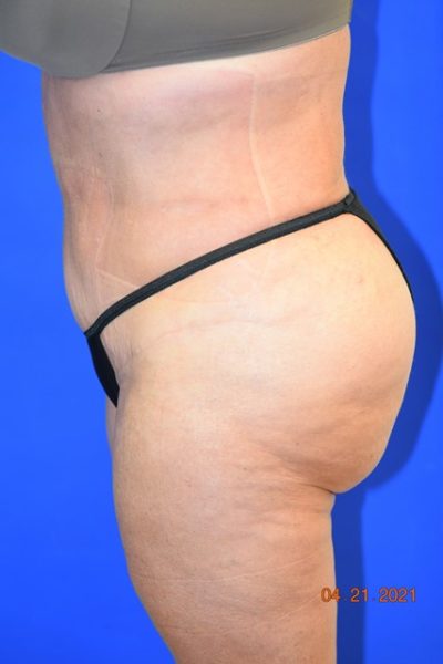 Body Procedures