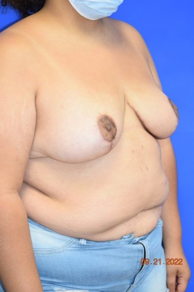 Breast Reduction