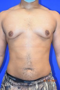 Male Breast Reduction