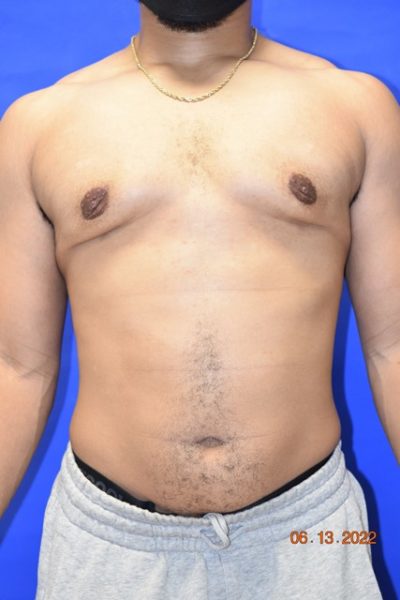 Male Breast Reduction