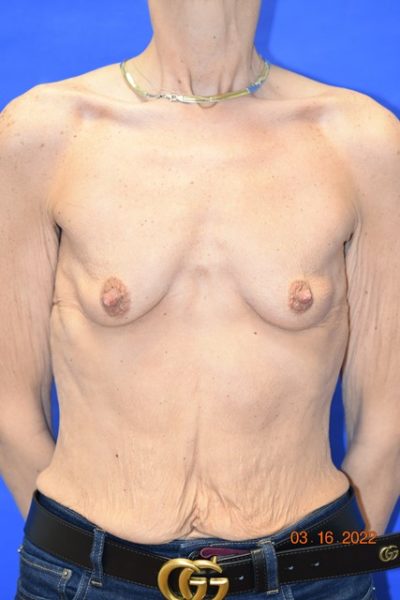 Breast Augmentation