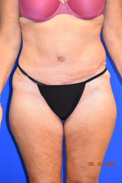 Tummy Tuck