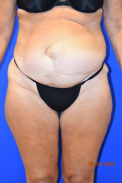 Tummy Tuck