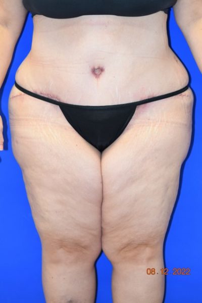 Tummy Tuck