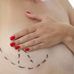 Doctor drew markers around breast in preparation for breast reconstruction
