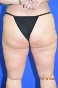 Liposuction