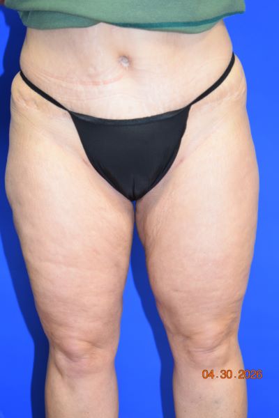 Liposuction
