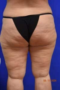 Liposuction