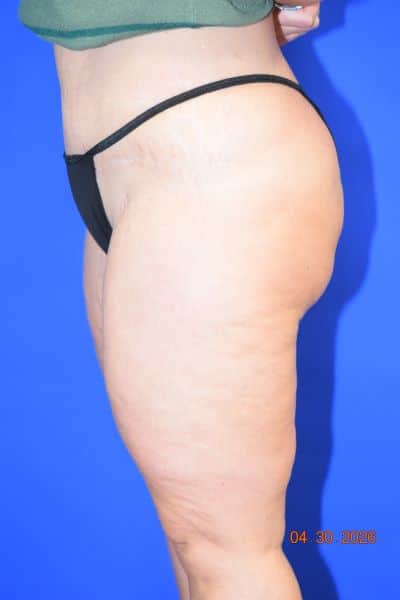 Liposuction